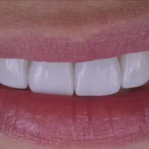 carillas dentales
